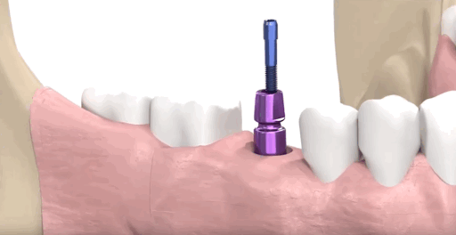 Установка абатмента