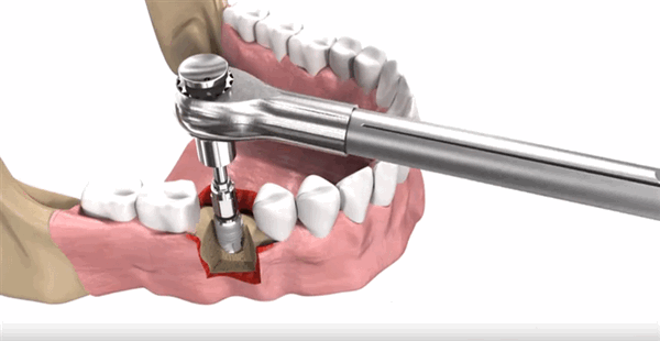Вживление корня