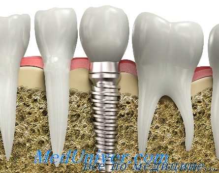 имплантация зубов