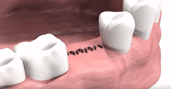 Ушивание десны