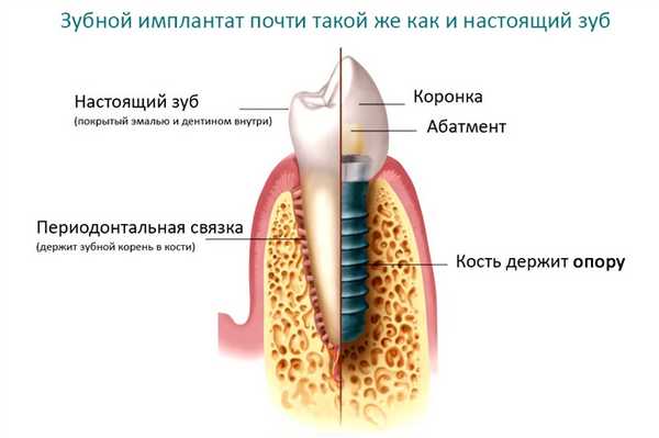 Установка имплантов пошагово