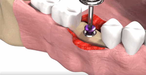 Установка заглушки