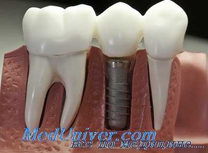 техники имплантации имплантата зубов