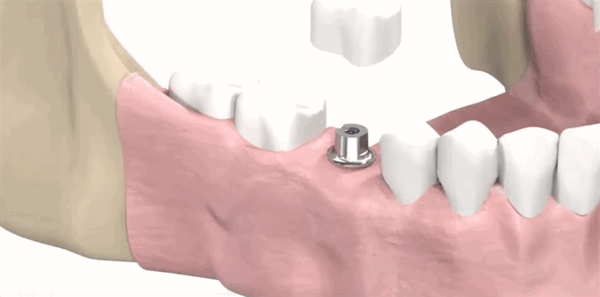 Коронка на имплант