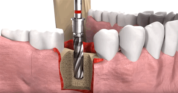 Расточка канала