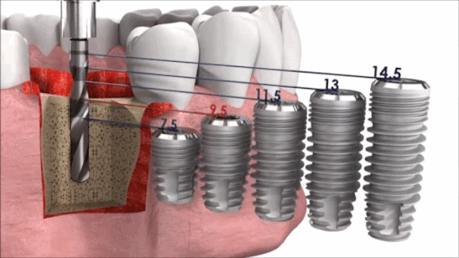 Формирование канала