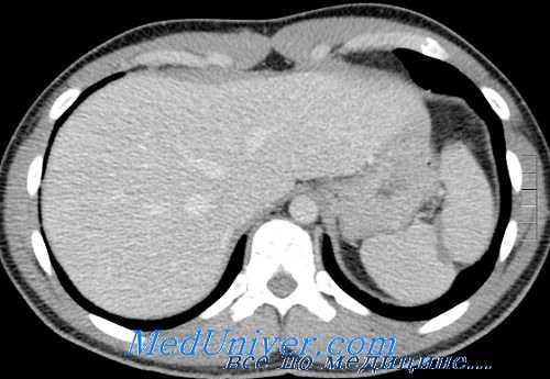 травма селезенки