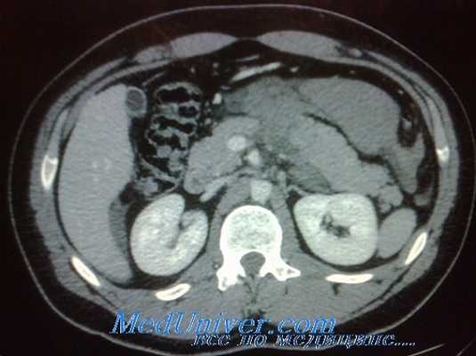 консервативное лечение травм селезенки