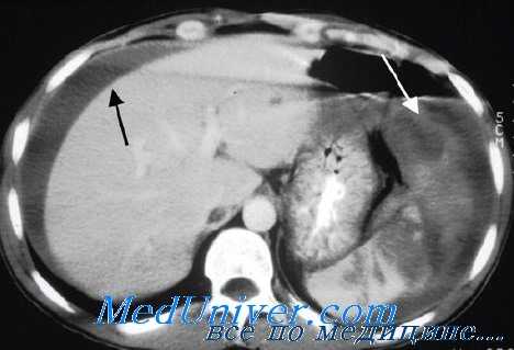 травма селезенки