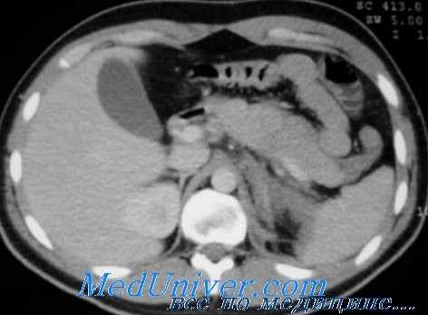 консервативное лечение травм селезенки