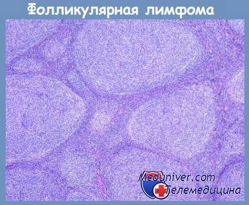 Фолликулярная лимфома
