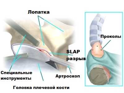SLAP артроскопия