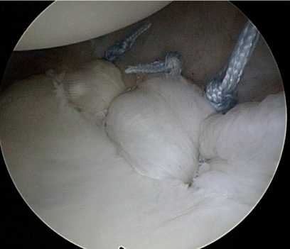 Фиксация банкарт