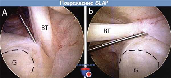 Повреждение SLAP плечевого сустава
