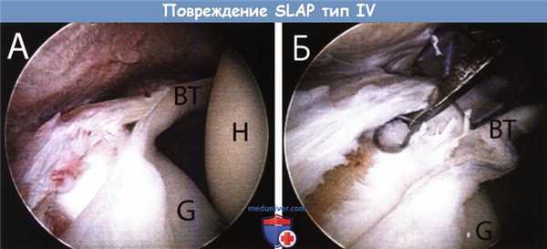 Операция при повреждении SLAP тип IV суставной губы плечевого сустава