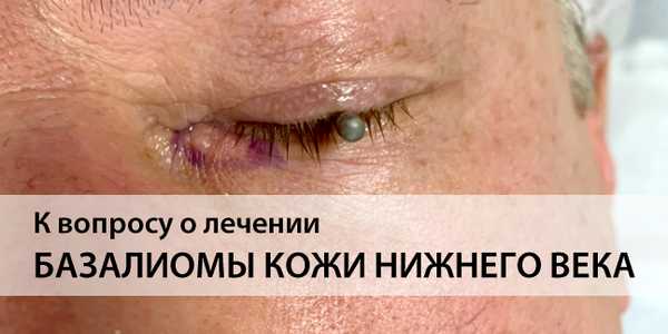 Лечение базалиомы кожи нижнего века