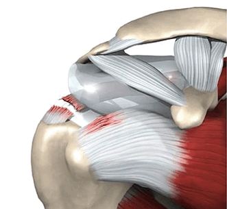 Разрыв вращательной манжеты плеча операция артроскопия