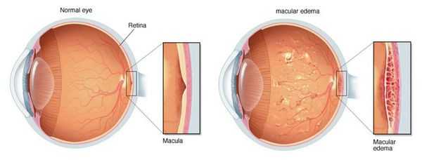 Макулярный отёк