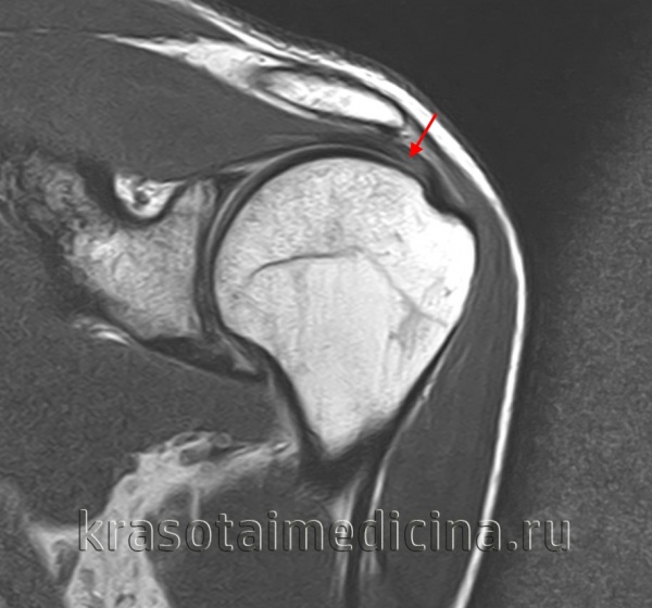 Повреждение сухожилий