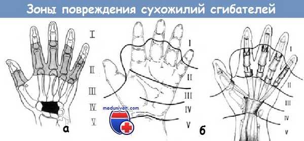 Зоны повреждения сухожилий сгибателей