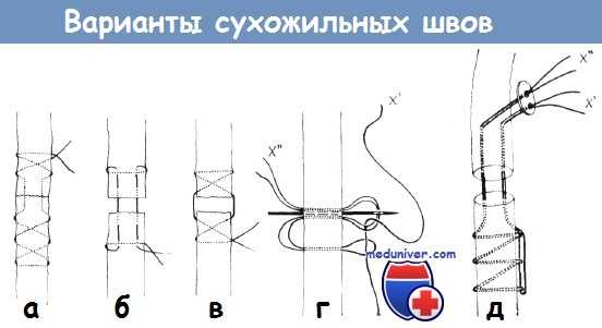 Варианты сухожильных швов