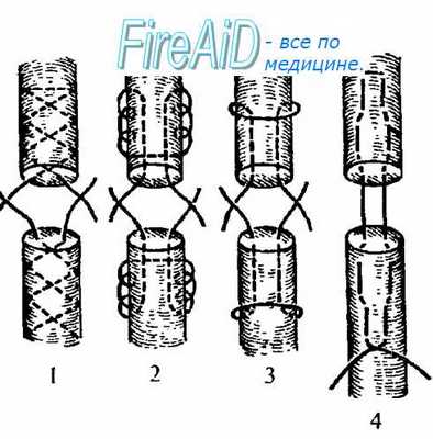 Виды внутриствольных адаптирующих швов сухожилия