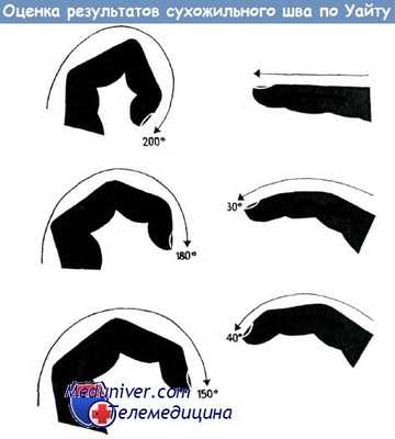 Оценка результатов сухожильного шва по Уайту