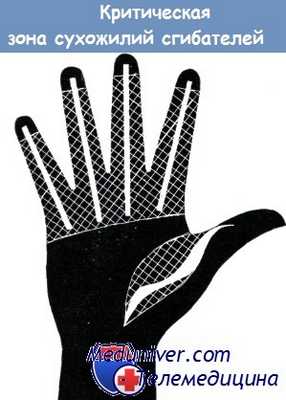 Критическая зона сухожилий сгибателей