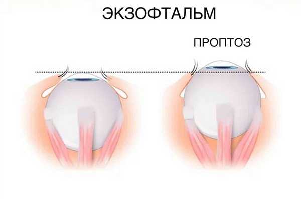 проптоз, экзофтальм