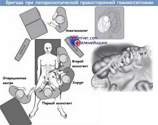Лапароскопическая правосторонняя гемиколэктомия