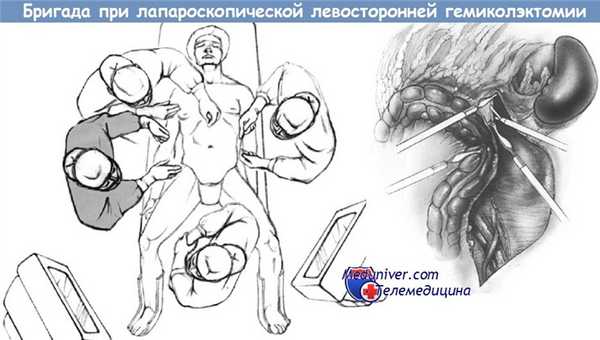 Лапароскопическая левосторонняя гемиколэктомия