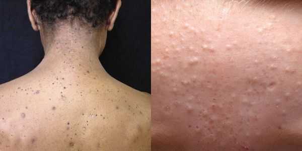 Комедоны на спине и лице