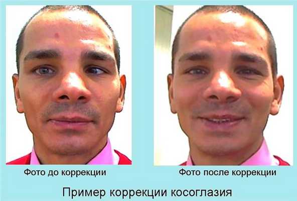 Виды операций на косоглазие