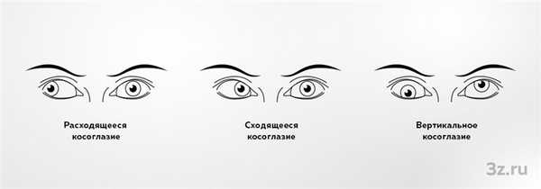 Виды косоглазия по типу отклонения