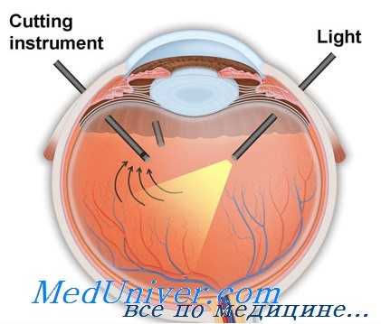 витрэктомия