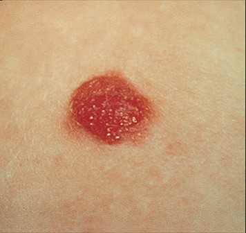 Неопасная родинка