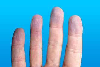 Цианоз конечностей при аортальном пороке сердца