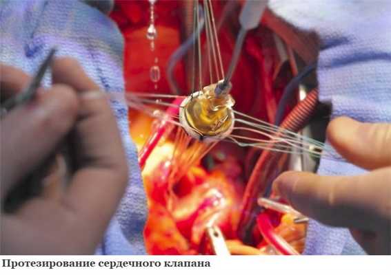 Протезирование сердечного клапана