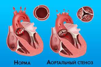 Нарушение клапанного аппарата аорты