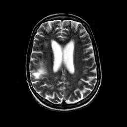 ПМЛ при СПИДе на поперечной Т2-зависимой томограмме
