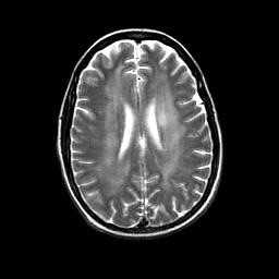 СПИД. Комплекс деменции на поперечной Т2-зависимой МРТ