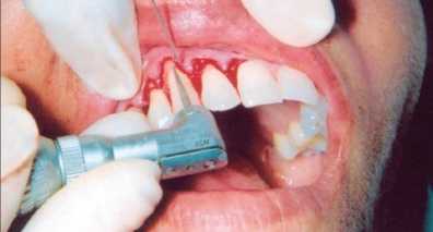 prisheechniy karies lecheniye