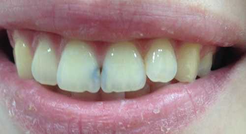 sredniy kariyes centralnih rezcov