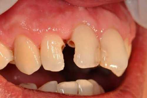 glubokiy kariyes rezcov