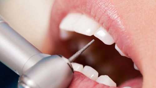 lechenie perednih zubov