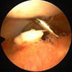Атроскопия. Суставная мышь после вывиха надколенника