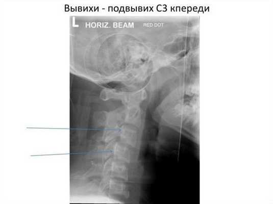 Подвывих С3 кпереди