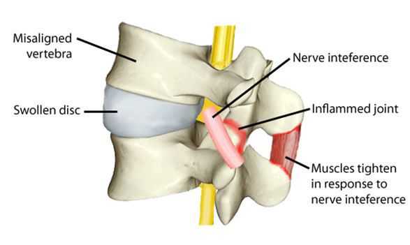 Раздражение нерва, воспаление, напряжение мышц