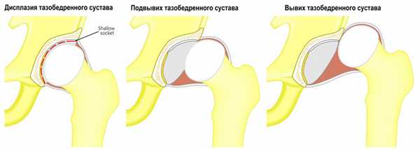 Тазобедренный сустав.jpg