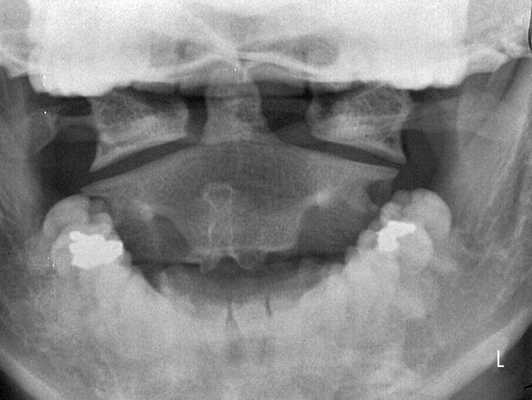 Подвывих позвонка С1